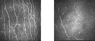 Small Fibre Neuropathy Is Associated With Impaired Vascular Endothelial Function in Patients With Type 2 Diabetes